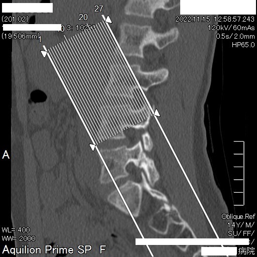 ●腰椎分離症11月15日CT癒合横編集済